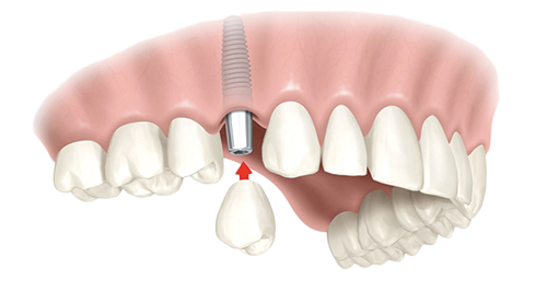 Single Dental Implants Kirkwood