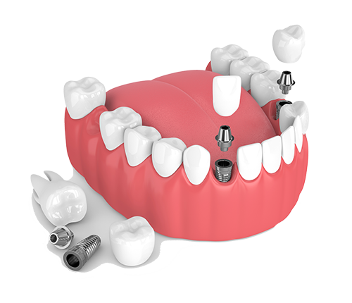 Multiple Teeth Dental Implants in Kirkwood